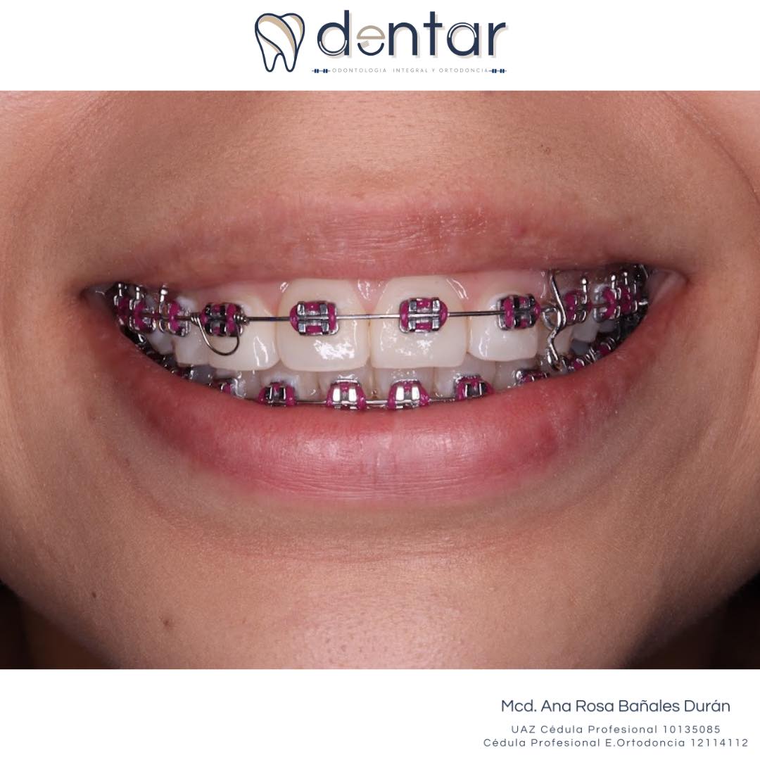 Tratamiento de brackets