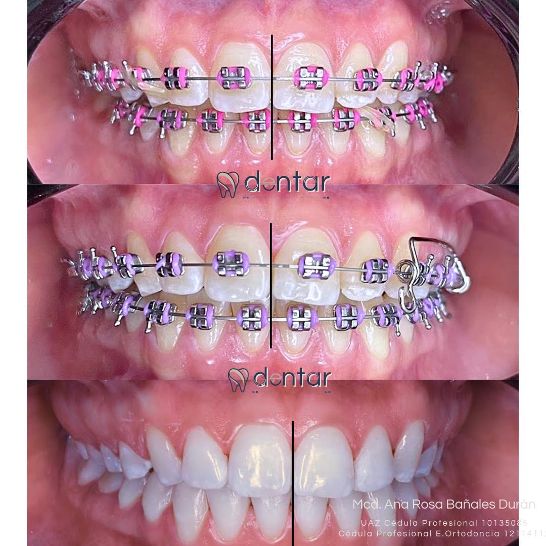 Alineación completa con brackets