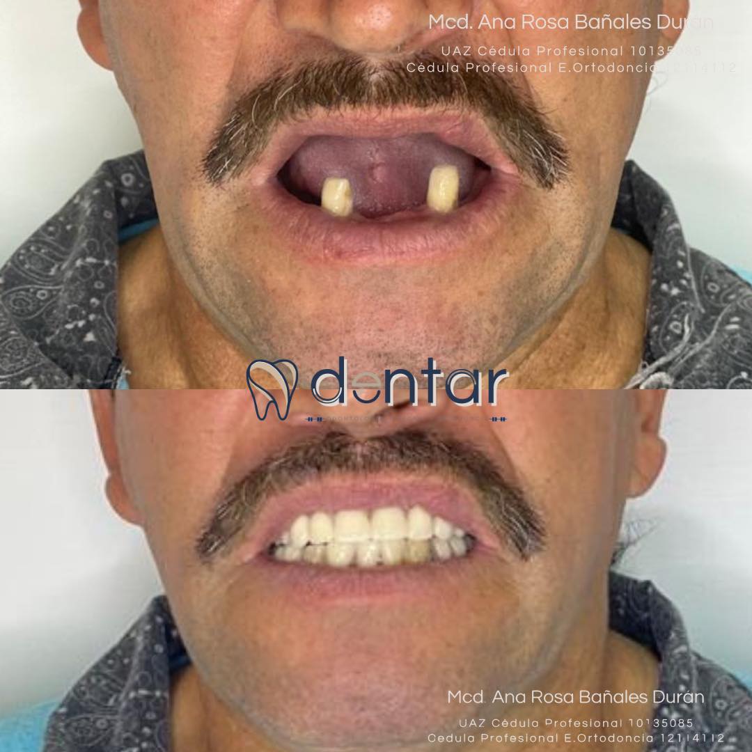 Restauración completa con implantes